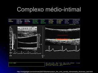 Complexo médio-intimalComplexo médio-intimal
http://medgadget.com/archives/2007/06/arteriovision_the_cimt_carotid_intimamedia_thickness_test.html
 
