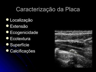 Caracterização da PlacaCaracterização da Placa
LocalizaçãoLocalização
ExtensãoExtensão
EcogenicidadeEcogenicidade
EcotexturaEcotextura
SuperfícieSuperfície
CalcificaçõesCalcificações
 