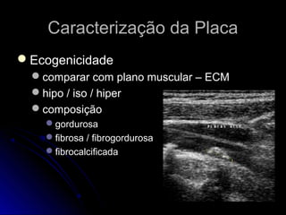 Caracterização da PlacaCaracterização da Placa
EcogenicidadeEcogenicidade
comparar com plano muscular – ECMcomparar com plano muscular – ECM
hipo / iso / hiperhipo / iso / hiper
composiçãocomposição
gordurosagordurosa
fibrosa / fibrogordurosafibrosa / fibrogordurosa
fibrocalcificadafibrocalcificada
 