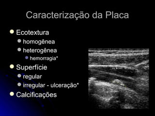 Caracterização da PlacaCaracterização da Placa
EcotexturaEcotextura
homogêneahomogênea
heterogêneaheterogênea
hemorragia*hemorragia*
SuperfícieSuperfície
regularregular
irregular - ulceração*irregular - ulceração*
CalcificaçõesCalcificações
 