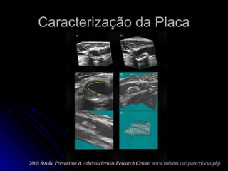 Caracterização da PlacaCaracterização da Placa
2008 Stroke Prevention & Atherosclerosis Research Centre www.robarts.ca/sparc/rfocus.php
 