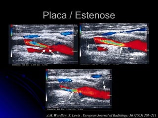 Placa / EstenosePlaca / Estenose
J.M. Wardlaw, S. Lewis . European Journal of Radiology: 56 (2005) 205–211
 