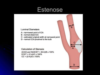 EstenoseEstenose
 