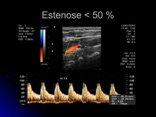 Estenose < 50 %Estenose < 50 %
 