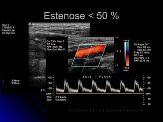 Estenose < 50 %Estenose < 50 %
 