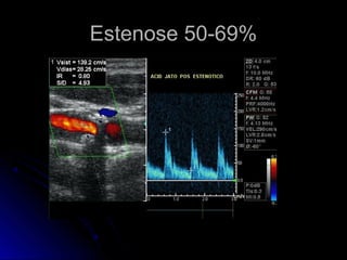Estenose 50-69%Estenose 50-69%
 