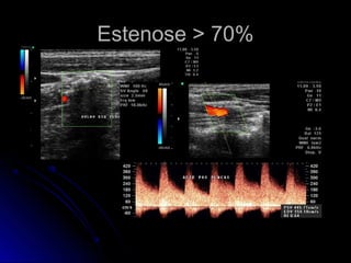 Estenose > 70%Estenose > 70%
 