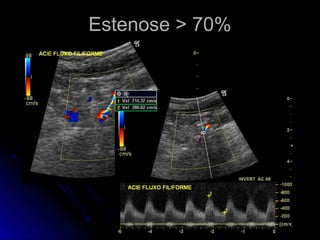 Estenose > 70%Estenose > 70%
 