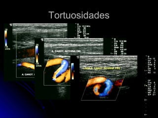 TortuosidadesTortuosidades
 