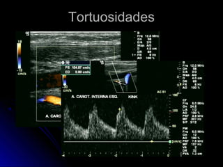 TortuosidadesTortuosidades
 