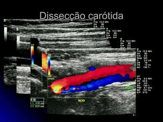 Dissecção carótidaDissecção carótida
 