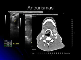AneurismasAneurismas
 