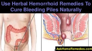 Use Herbal Hemorrhoid Remedies To
Cure Bleeding Piles Naturally

AskHomeRemedies.com

 