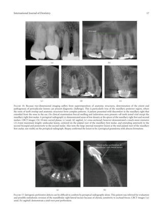 Use of cone beam computed tomography in endodontics | PDF