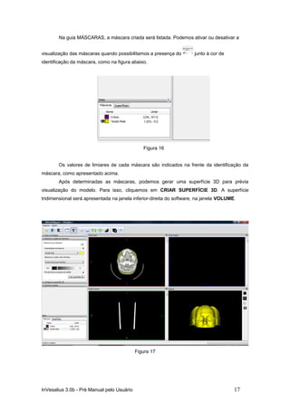 Na guia MÁSCARAS, a máscara criada será listada. Podemos ativar ou desativar a


visualização das máscaras quando possibilitamos a presença do         junto à cor de
identificação da máscara, como na figura abaixo.




                                               Figura 16


       Os valores de limiares de cada máscara são indicados na frente da identificação da
máscara, como apresentado acima.
       Após determinadas as máscaras, podemos gerar uma superfície 3D para prévia
visualização do modelo. Para isso, cliquemos em CRIAR SUPERFÍCIE 3D. A superfície
tridimensional será apresentada na janela inferior-direita do software, na janela VOLUME.




                                            Figura 17




InVesalius 3.0b - Pré Manual pelo Usuário                                               17
 