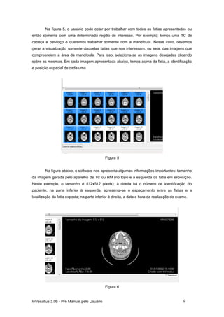 Na figura 5, o usuário pode optar por trabalhar com todas as fatias apresentadas ou
então somente com uma determinada região de interesse. Por exemplo: temos uma TC de
cabeça e pescoço e queremos trabalhar somente com a mandíbula. Nesse caso, devemos
gerar a visualização somente daquelas fatias que nos interessam, ou seja, das imagens que
compreendem a área da mandíbula. Para isso, seleciona-se as imagens desejadas clicando
sobre as mesmas. Em cada imagem apresentada abaixo, temos acima da fatia, a identificação
e posição espacial de cada uma.




                                             Figura 5


        Na figura abaixo, o software nos apresenta algumas informações importantes: tamanho
da imagem gerada pelo aparelho de TC ou RM (no topo e à esquerda da fatia em exposição.
Neste exemplo, o tamanho é 512x512 pixels); à direita há o número de identificação do
paciente; na parte inferior à esquerda, apresenta-se o espaçamento entre as fatias e a
localização da fatia exposta; na parte inferior à direita, a data e hora da realização do exame.




                                             Figura 6


InVesalius 3.0b - Pré Manual pelo Usuário                                                    9
 