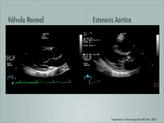 Cardiopatia Reumatica