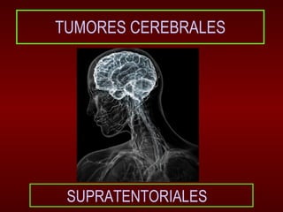 TUMORES CEREBRALES




 SUPRATENTORIALES
 