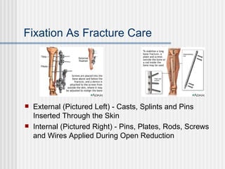 Types of Fractures | PPT
