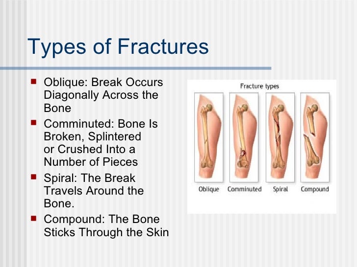 different types of bone fracture