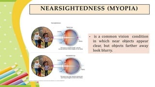• is a common vision condition
in which near objects appear
clear, but objects farther away
look blurry.
NEARSIGHTEDNESS (MYOPIA)
 