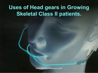 Uses of Head gears in Growing
Skeletal Class II patients.

www.indiandentalacademy.com

 