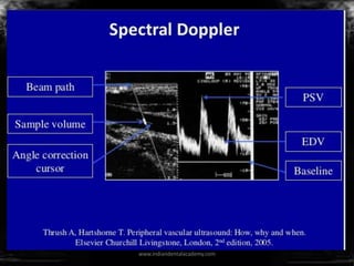 Spectral doppler
www.indiandentalacademy.com
 