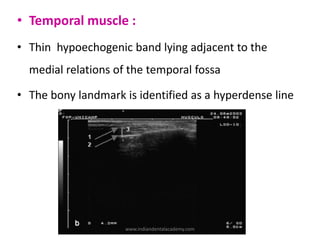 • Temporal muscle :
• Thin hypoechogenic band lying adjacent to the
medial relations of the temporal fossa
• The bony land...