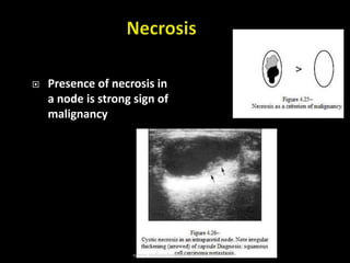  Presence of necrosis in
a node is strong sign of
malignancy
www.indiandentalacademy.com
 