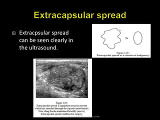  Extracpsular spread
can be seen clearly in
the ultrasound.
www.indiandentalacademy.com
 