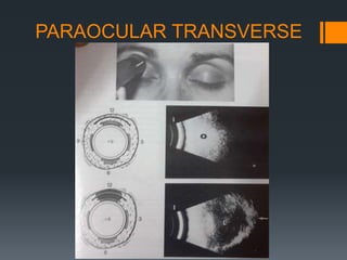 PARAOCULAR TRANSVERSE
 