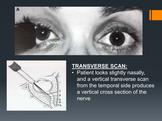 TRANSVERSE SCAN:
• Patient looks slightly nasally,
and a vertical transverse scan
from the temporal side produces
a vertical cross section of the
nerve
 