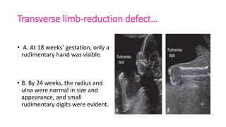 Ultrasound and usg doppler in obstetrics | PPTX