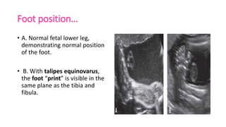 Ultrasound and usg doppler in obstetrics | PPTX | Pregnancy ...