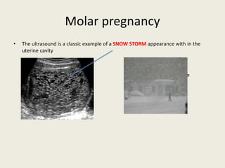 Molar pregnancy
• The ultrasound is a classic example of a SNOW STORM appearance with in the
uterine cavity
=
 
