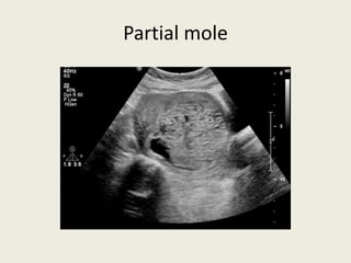 Partial mole
 