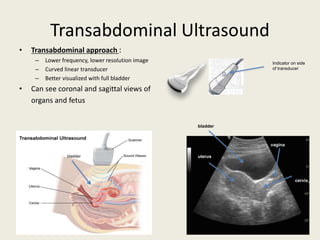 Transabdominal Ultrasound
• Transabdominal approach :
– Lower frequency, lower resolution image
– Curved linear transducer
– Better visualized with full bladder
• Can see coronal and sagittal views of
organs and fetus
Indicator on side
of transducer
bladder
uterus
vagina
cervix
bladder
 