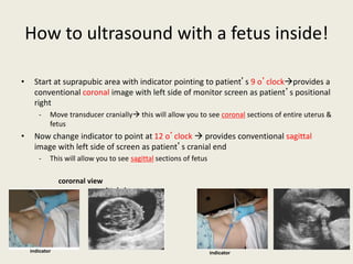 How to ultrasound with a fetus inside!
• Start at suprapubic area with indicator pointing to patient’s 9 o’clockprovides a
conventional coronal image with left side of monitor screen as patient’s positional
right
- Move transducer cranially this will allow you to see coronal sections of entire uterus &
fetus
• Now change indicator to point at 12 o’clock  provides conventional sagittal
image with left side of screen as patient’s cranial end
- This will allow you to see sagittal sections of fetus
corornal view
sagittal view
indicator indicator
 