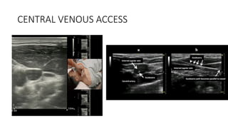 CENTRAL VENOUS ACCESS
 