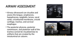 AIRWAY ASSESSMENT
• Airway ultrasound can visualize and
assess the tongue, oropharynx,
hypopharynx, epiglottis, larynx, vocal
cords, cricothyroid membrane, cricoid
cartilage, trachea, and cervical
esophagus
• The posterior pharynx, posterior
commissure, and posterior wall of the
trachea cannot be visualized due to
artifacts that are created by the
intraluminal air column.
 