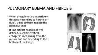 PULMONARY EDEMA AND FIBROSIS
• When the pulmonary interstitium
thickens (secondary to fibrosis or
fluid), B-line artifacts replace the
normal A-lines
• B-line artifact consists of well-
defined, laserlike, vertical,
echogenic lines arising from the
pleural line and extending to the
bottom of the image.
 