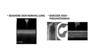 • SEASHORE SIGN-NORMAL LUNG • BARCODE SIGN -
PNEUMOTHORAX
 