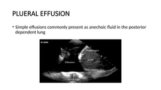 PLUERAL EFFUSION
• Simple effusions commonly present as anechoic fluid in the posterior
dependent lung
 