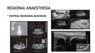 REGIONAL ANAESTHESIA
• CENTRAL NEURAXIAL BLOCKADE
 