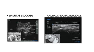 • EPIDURAL BLOCKADE CAUDAL EPIDURAL BLOCKADE
 
