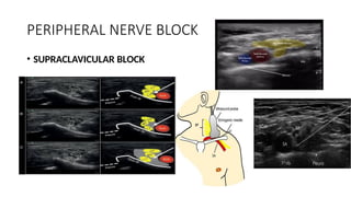 PERIPHERAL NERVE BLOCK
• SUPRACLAVICULAR BLOCK
 