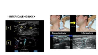 • INTERSCALENE BLOCK
 