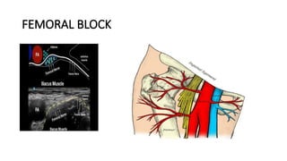 FEMORAL BLOCK
 