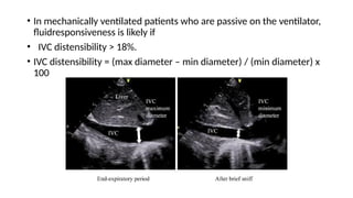 • In mechanically ventilated patients who are passive on the ventilator,
fluidresponsiveness is likely if
• IVC distensibility > 18%.
• IVC distensibility = (max diameter – min diameter) / (min diameter) x
100
 