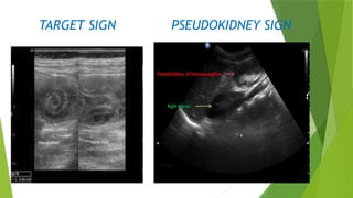 Apendix Target. Sign USG Acute abdomen radiology imaging .pptx
